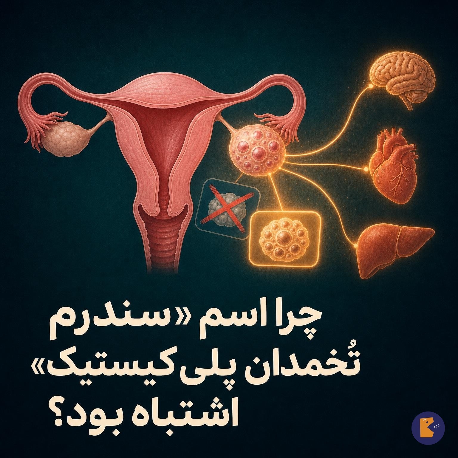 چرا اسم «سندرم تُخمدان پلی‌کیستیک» اشتباه بود؟